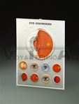 Eye Disorders 3D Lenticular Anatomical Chart